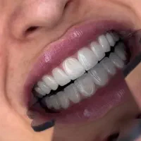 کامپوزیت دندان با قیمت باور نکردنی ۹۶۰۰