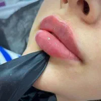 جشنواره تزریق فیلر، ژل ،بوتاکس به مدت محدود