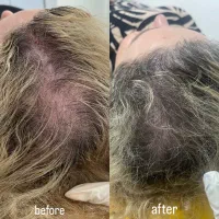 تزریق ژل، بوتاکس، PRP و مزوتراپی