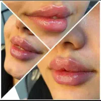 تزریق ژل ،بوتاکس، مزوژل جوانساز،توسط پزشک