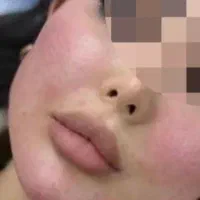 قیمت ها واقعی است فول فیس فیلر ده سی سی ۲تومن