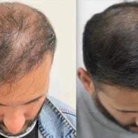 از در اومدن موهات نترس