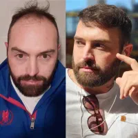 کاشت مو، بررسی عکس و اعلام هزینه
