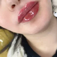 انجام کلیه خدمات فیلربادی،فیلر،بوتاکس،مزو و مزوژل