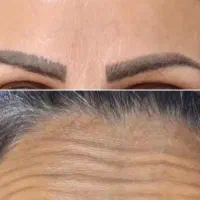آف ویژه تزریق ژل و بوتاکس