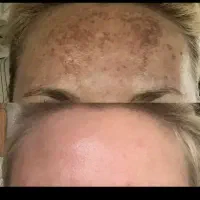 تیرگی ها وکک ومک رو نابود کن تضمینی و بدون بازگشت