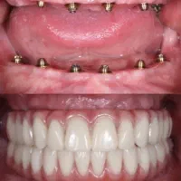 ایمپلنت/ اوردنچر تخصصی /اقساطی+وام پزشکی+ضمانت