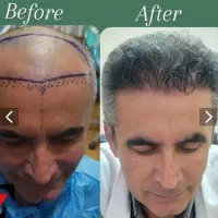 کاشت مو و ریش و ابرو با تراکم طبیعی و بالا