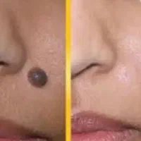 برداشتن خال زگیل زائده گوشتی