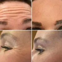تخفیف ویژه برداشت انواع خال و تزریق بوتاکس مصبورت
