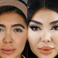 لیفت فول فیس صورت و شقیقه بدون عمل جراحی