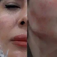 تزریق ژل و بوتاکس تخصصی