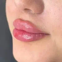 تزریق فیلر