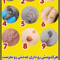 بهبود قطعی و تضمینی زگیل تناسلی (hpv و hsv)