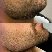 لیزر،ژل بوتاکس خال وزائده گوشتی، فیبروز ابروآقایان