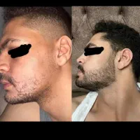 رشد سریع و یکنواخت ریش و سبیل
