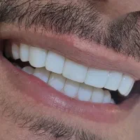 کامپوزیت دندان. روکش. لمینت
