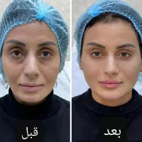 ژل لب زاویه خط خنده مزوبوتاکس prpتخصصی لیزرموزائد