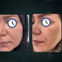 بهبود ماکولار آمیلوئیدوز و مشکلات پوستی