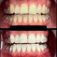 بلیچینگ و جرمگیری + پکیج های تخفیفی
