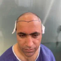 کاشت مو به صورت کاملا طبیعی