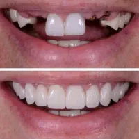 اعتبار قرض الحسنه ۵۰۰ میلیونی دندانپزشکی و ایمپلنت