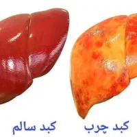 درمان اصولی کبد چرب