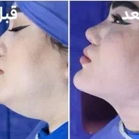 ساکشن غبغب با تکنیک V-Line