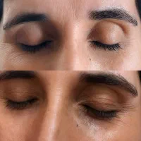 کرم و سرم دور چشم