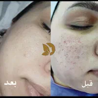 تو یک جلسه فقط سلول بنیادی میتونه این نتیجه را بده