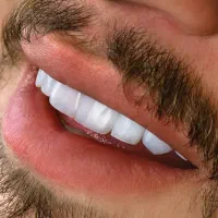 دندانپزشکی ایمپلنت  کامپوزیت عصب کشی  روکش