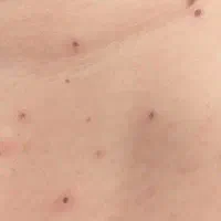 برداشت انواع خال و زگیل منگول