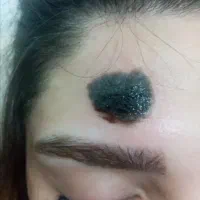 برداشتن خال و زگیل ب روش طب سنتی