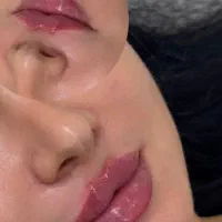 فول فیس روفیل۸۹۰۰ژل۸۵۰بوتاکس۷۵۰ توسط پزشک