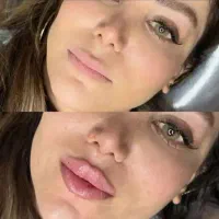 جشنواره کلینیک ژل لب فیلرزیرچشم،شقیقه۷۰۰بوتاکس مزو