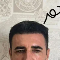 تکنسین کاشت مو