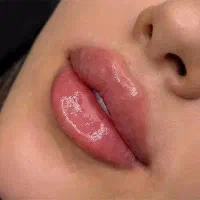 مدل برای ژل و بوتاکس