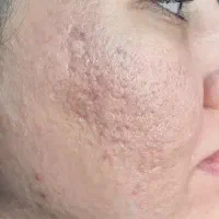 جشنواره 50% تزریق پروتئین ،PRPمعجزه ترمیم پوست
