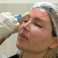 تزریق prp مو و پوست ،مزو برند فیوژن فقط ۱۵۰۰