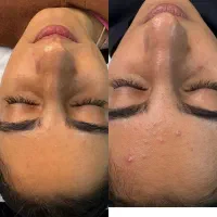 خدمات فیشال،پاکسازی پوست پی آرپی وهایفو