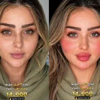 تزریق ژل بوتاکس لیفت صورت وشقیقه آنزیم مزو