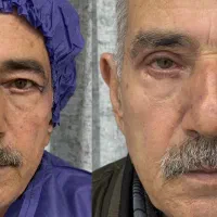 بلفاروپلاستی تضمینی چشم با پزشک مجرب