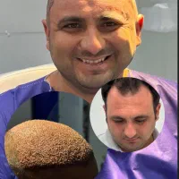 کاشت مو و کاشت ابرو