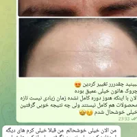بوتاکس در منزل بدون تزریق