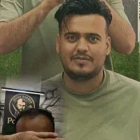 پروتز مو در مرکز تخصصی/ نصب فوری / انجام خدمات