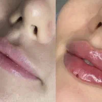 جشنواره تخفیف ژل لب،بوتاکس،فیلرشقیقه توسط پزشک