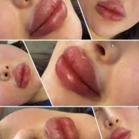 ژل و بوتاکس و مزو سر و صورت نخ فول فیس50/۰تخفیف