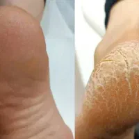 رفع خشکی و ترک پا بدون پدیکور و بدون هزینه