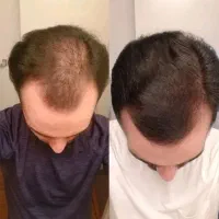 محلول قطع ریزش و رویش مجدد مو