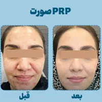 جوانیه گندم تپلی صورت
